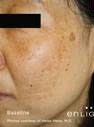 Before Treatment at Original You in Las Vegas