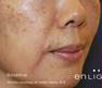Before Treatment at Original You in Las Vegas