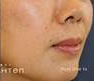 After Treatment at Original You in Las Vegas