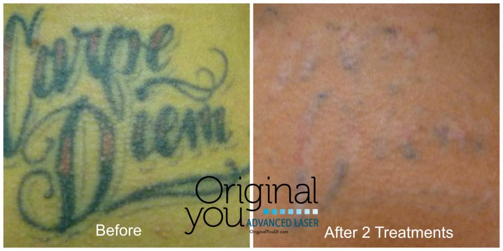 Laser Tattoo Removal, Before & After 2 Treatments