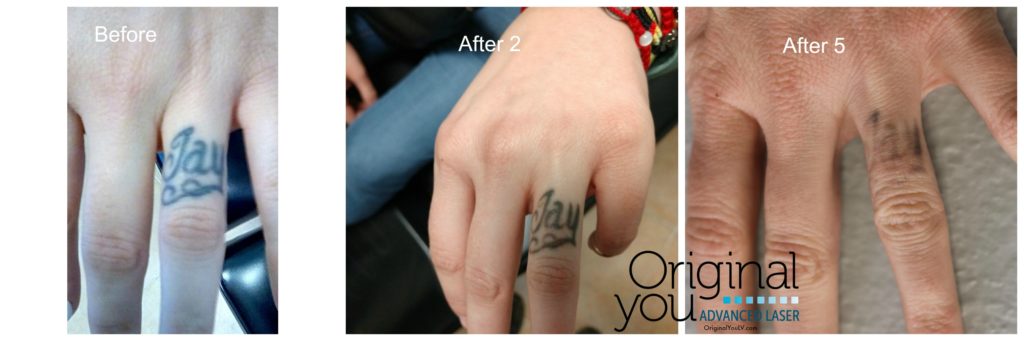 Laser Tattoo Removal on ring finger. Before, after 2 treatments and after 5 treatments.