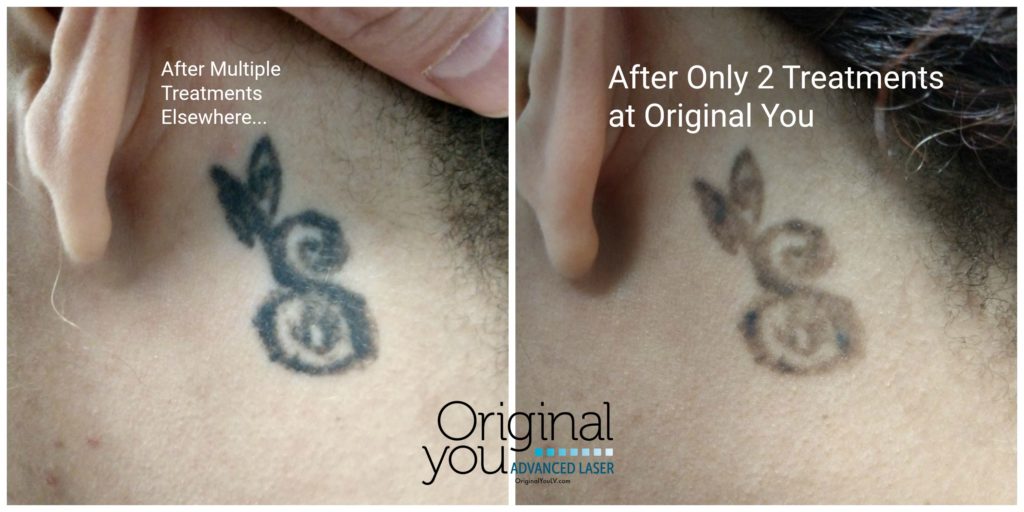 Laser Tattoo Removal on neck. Before and after 2 treatments.