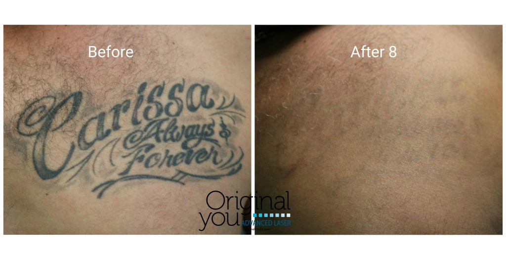 Laser Tattoo Removal of a name tattoo. Before and after 8 treatments.