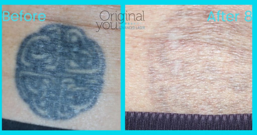 Laser Tattoo Removal of Celtic knot. Before and after eight treatments.