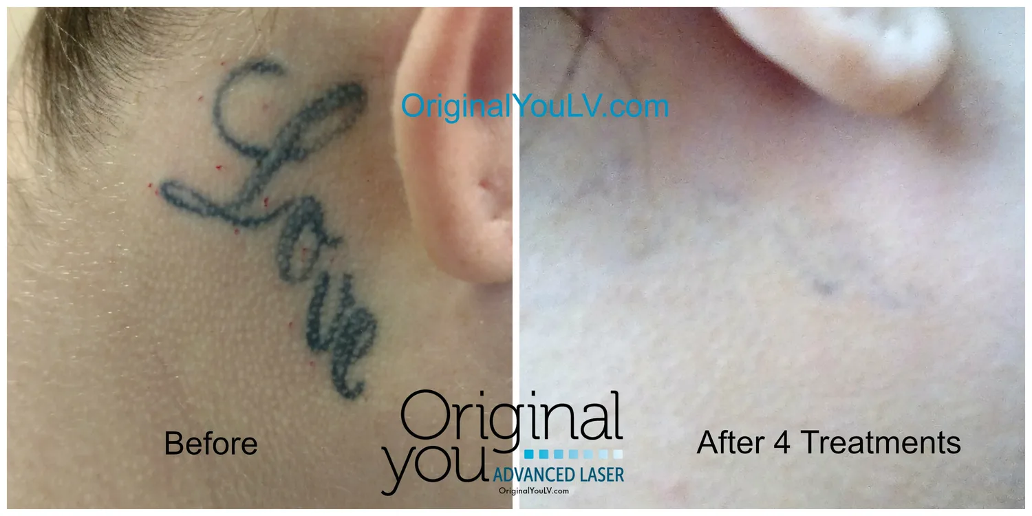 Neck script tattoo before and after 4 laser tattoo removal treatments at Original You Las Vegas
