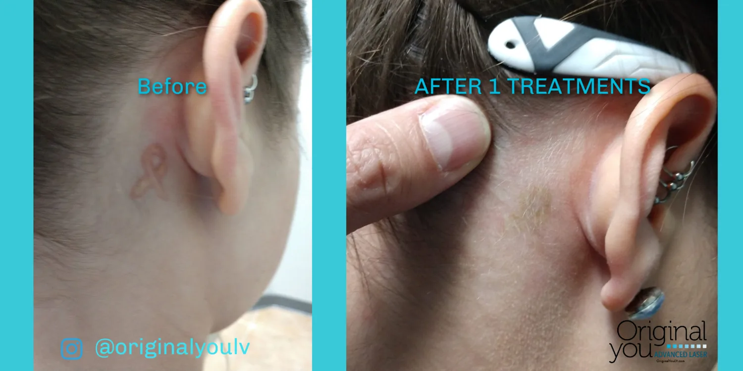 Small tattoo behind the ear removed after two laser treatments at Original You