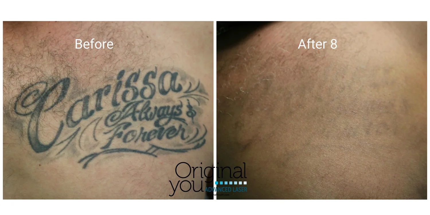 Large script name tattoo on the back before and after 8 laser tattoo removal sessions