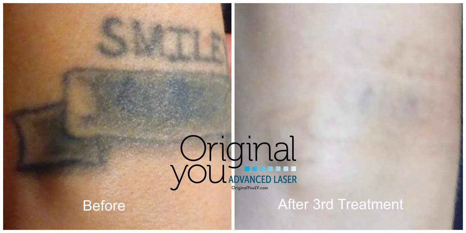 Script lettering tattoo on the forearm before treatment and after 3 laser tattoo removal sessions at Original You in Las Vegas