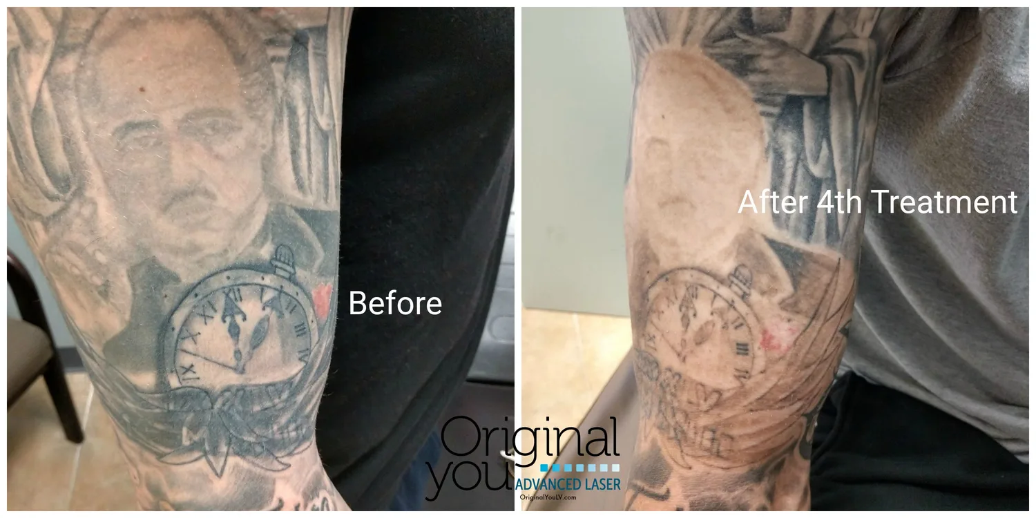Full sleeve portrait tattoo before and after 4 laser tattoo removal treatments in Las Vegas
