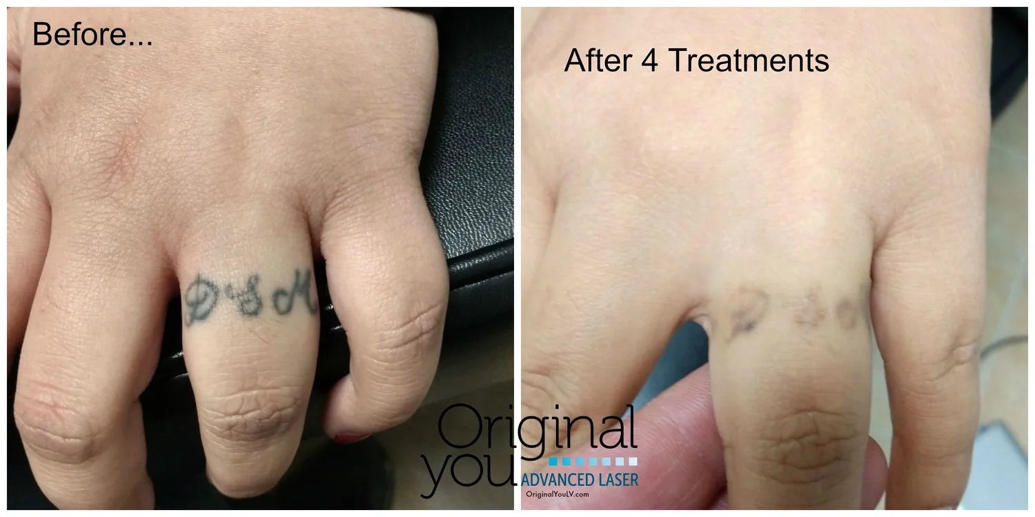 Hand and finger tattoo before and after 4 laser tattoo removal treatments in Las Vegas