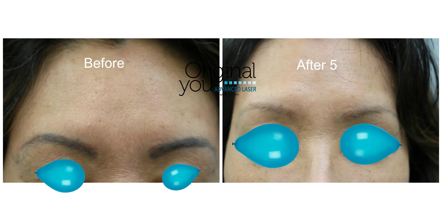 Microblading and PMU Removal in Las Vegas at Original You