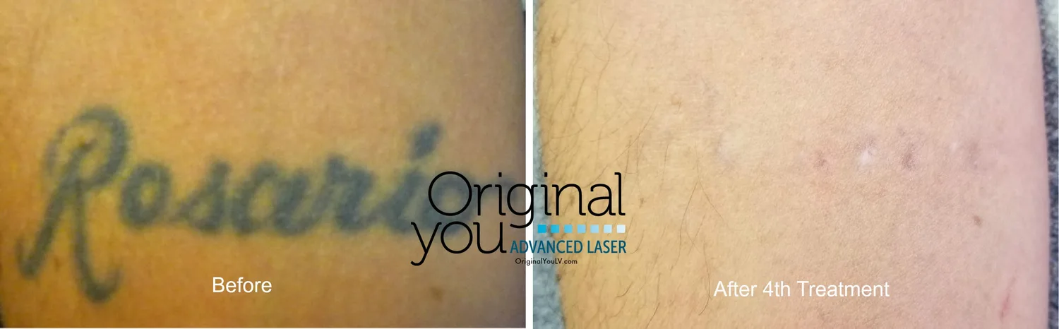 Faded script tattoo before and after multiple pico laser tattoo removal sessions