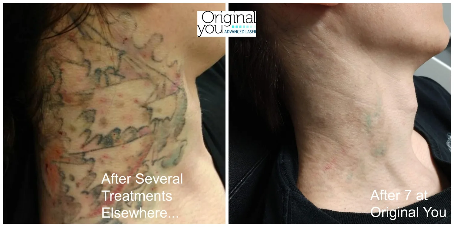 Large chest and neck tattoo cleared after treatment at Original You following several sessions elsewhere