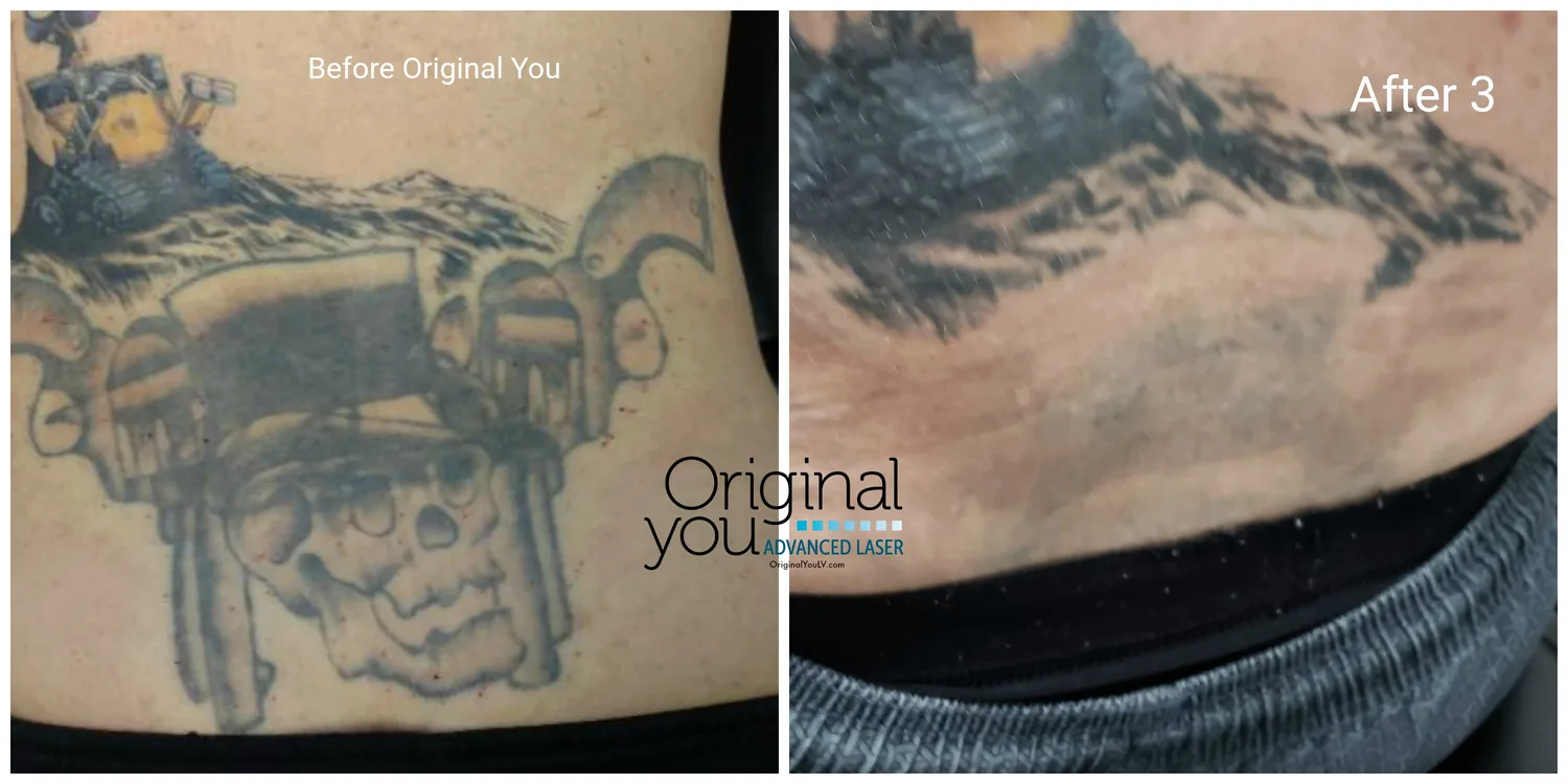 Large dense black shoulder tattoo before and after 3 pico laser tattoo removal sessions