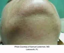 Laser hair removal before and after results at Original You Las Vegas