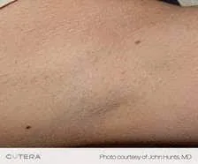 Laser hair removal treatment area before and after at Original You Las Vegas