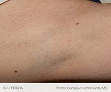 After Treatment at Original You in Las Vegas