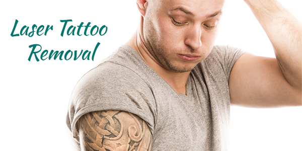 laser tattoo removal
