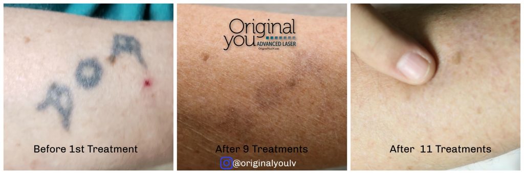 Laser Tattoo Removal progression photos. Before, After eight treatments and after eleven treatments
