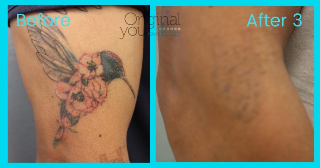 Laser Tattoo Removal of color hummingbird tattoo on leg. Before and After three treatments